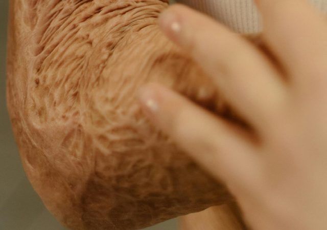 Quemaduras con pólvora - Fórmula Médica Quemaduras con pólvora - Fórmula Médica
