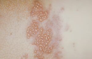 Llamado de la Cruz Roja Bogotá en la Semana de Concientización sobre el Herpes Zóster Herpes Zóster - Fórmula Médica