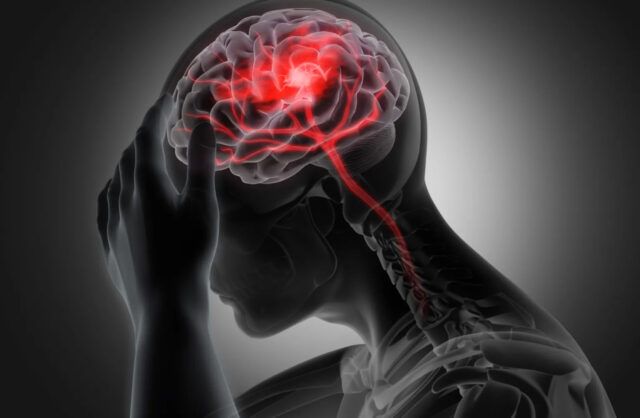 Ataque Cerebrovascular - Fórmula Médica