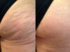New Body amplía su apuesta tecnológica con la campaña “No Más Celulitis en Colombia” La celulitis afecta hasta al 90% de las mujeres - Fórmula Médica