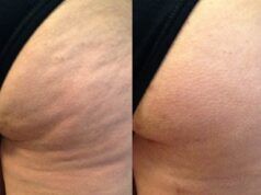 New Body amplía su apuesta tecnológica con la campaña “No Más Celulitis en Colombia” La celulitis afecta hasta al 90% de las mujeres - Fórmula Médica