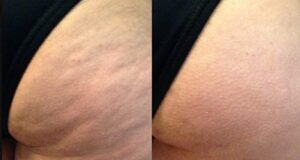 New Body amplía su apuesta tecnológica con la campaña “No Más Celulitis en Colombia” La celulitis afecta hasta al 90% de las mujeres - Fórmula Médica