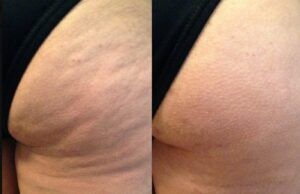 New Body amplía su apuesta tecnológica con la campaña “No Más Celulitis en Colombia” La celulitis afecta hasta al 90% de las mujeres - Fórmula Médica