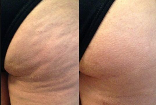 New Body amplía su apuesta tecnológica con la campaña “No Más Celulitis en Colombia” La celulitis afecta hasta al 90% de las mujeres - Fórmula Médica