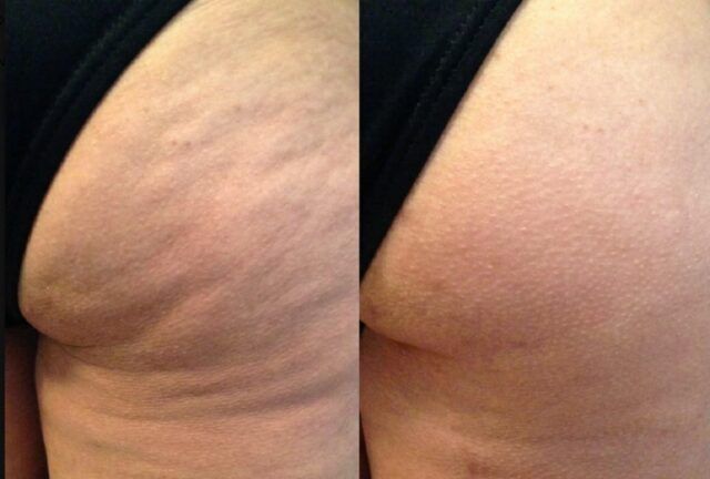 La celulitis afecta hasta al 90% de las mujeres - Fórmula Médica